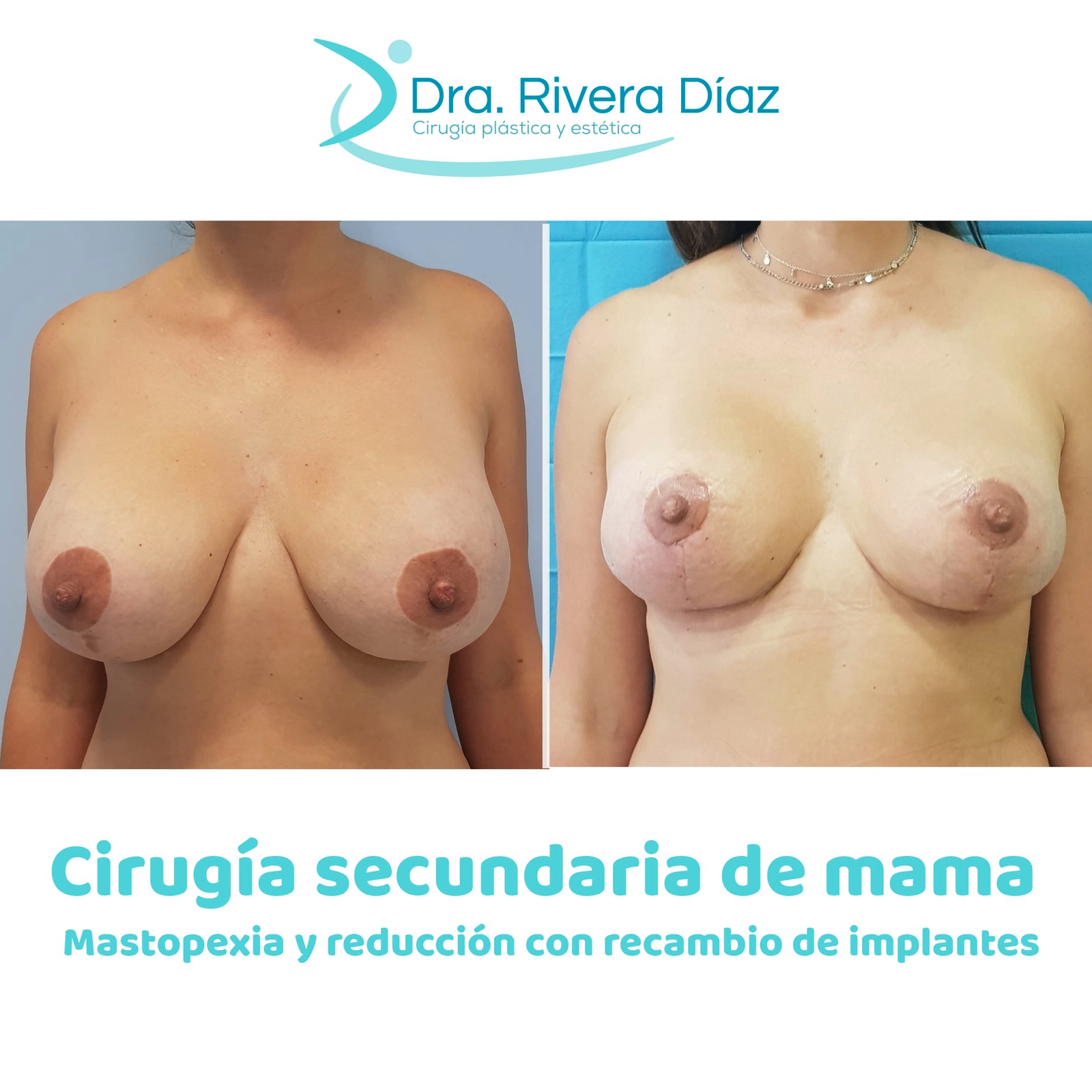 Cirugia Mamas 01